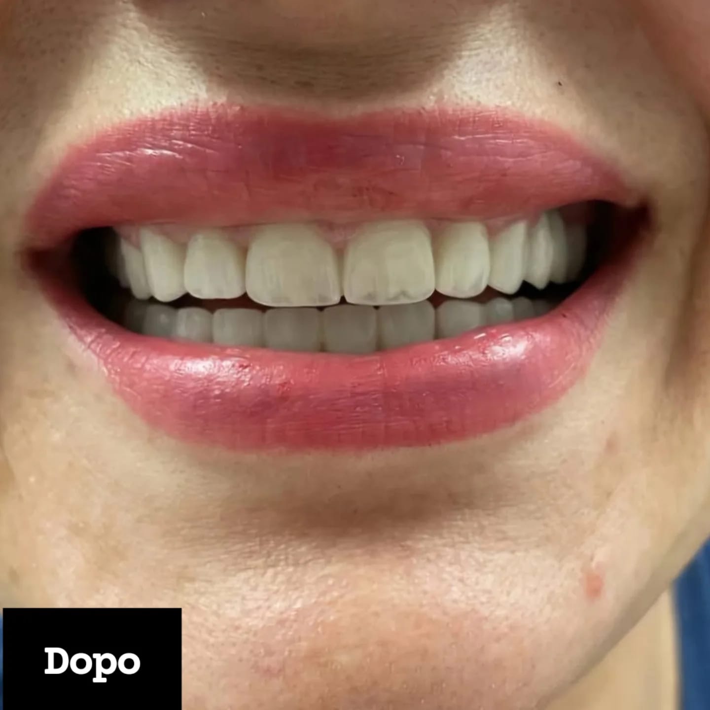 Dopo il trattamento dentale