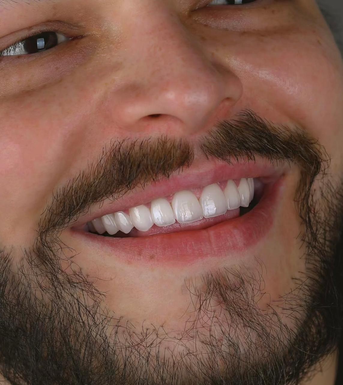 Dopo il trattamento dentale