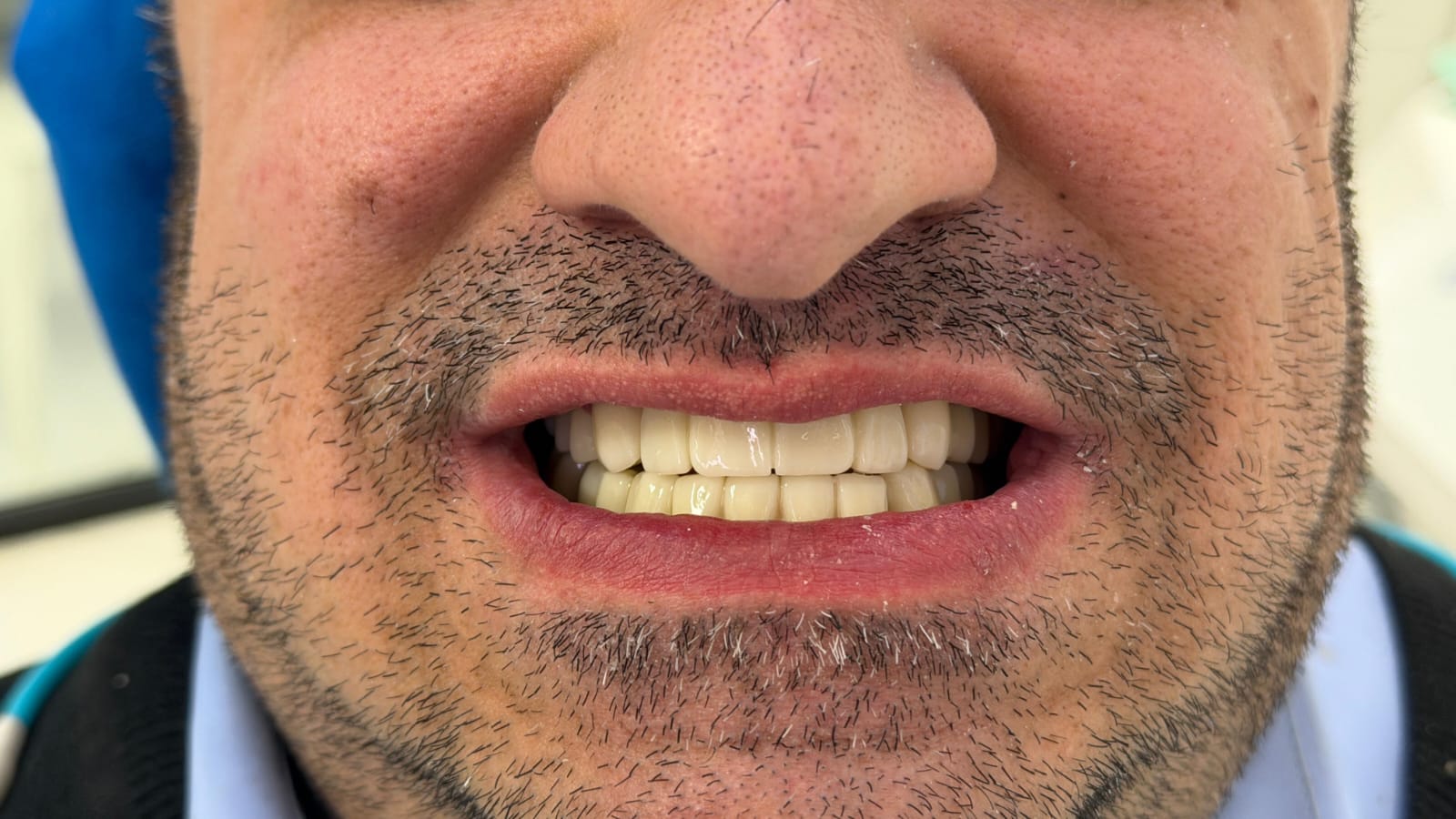 Dopo il trattamento dentale