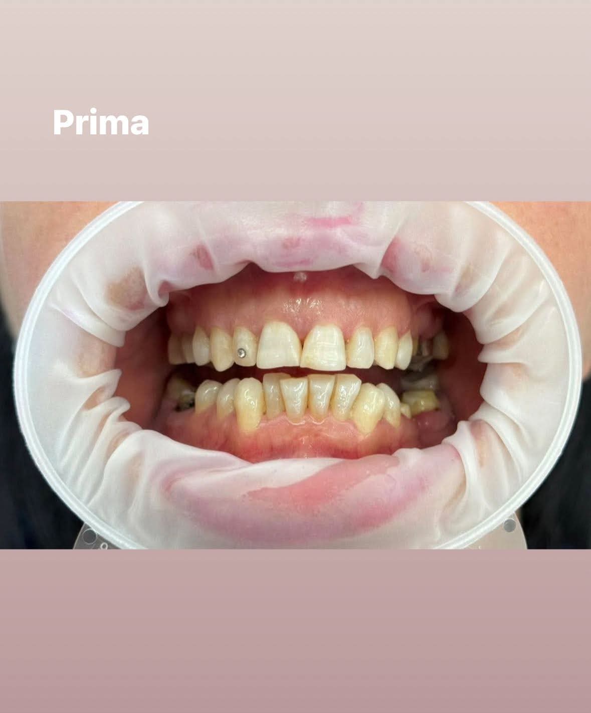 Prima del trattamento dentale