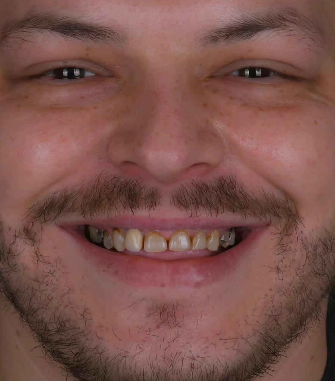 Prima del trattamento dentale