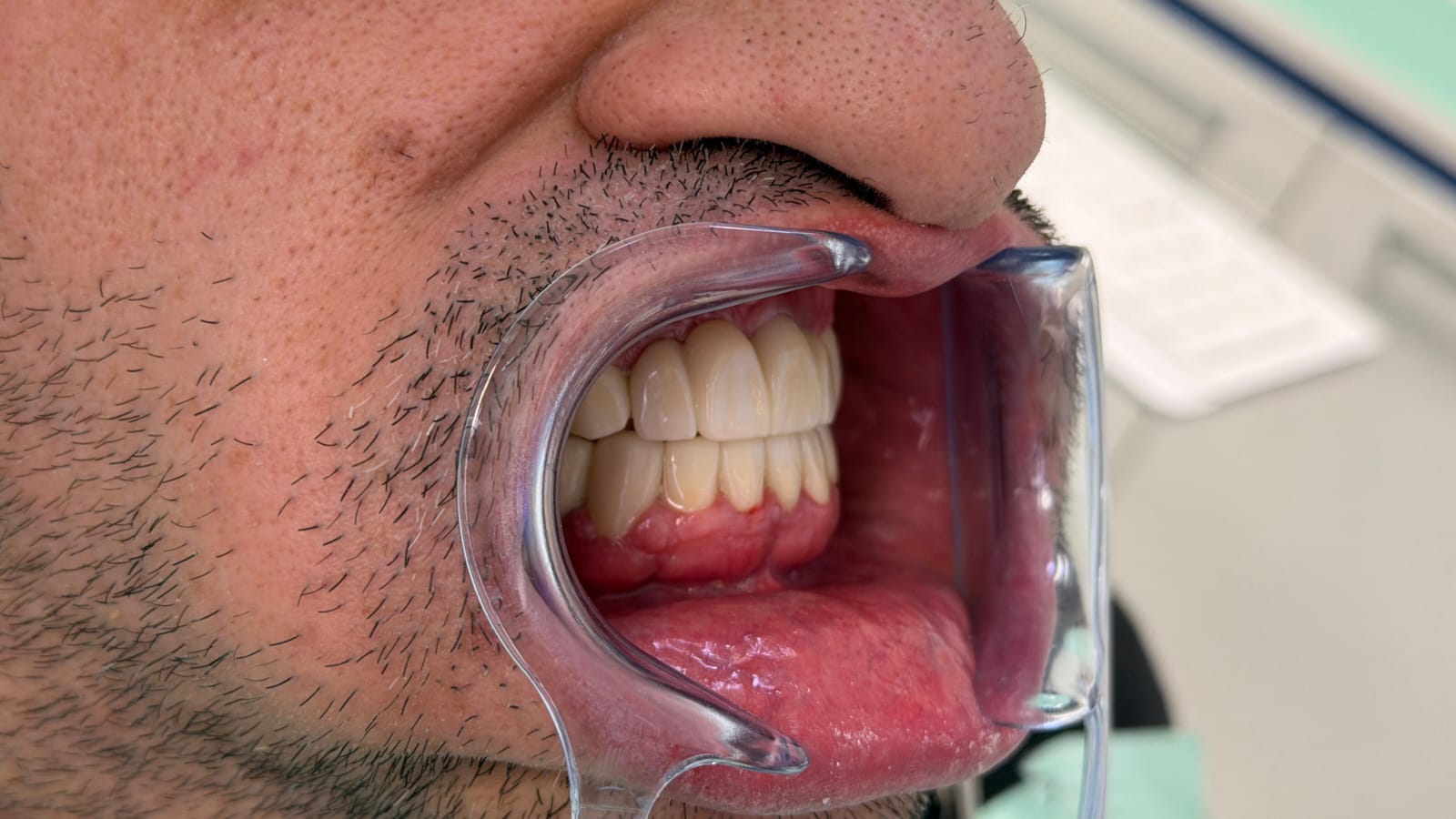 Prima del trattamento dentale